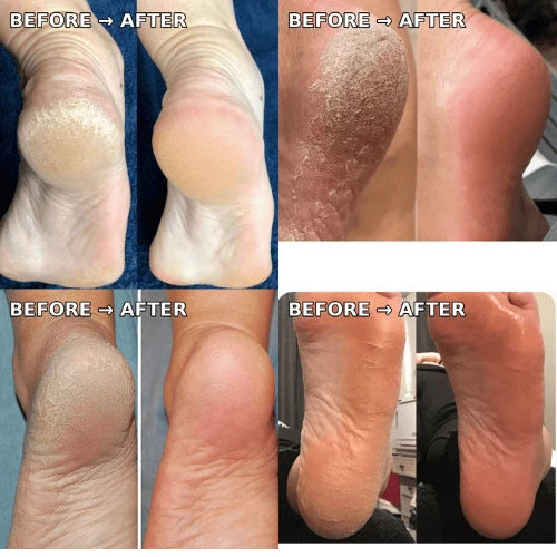 Electric Pedicure Foot File Callus Remover